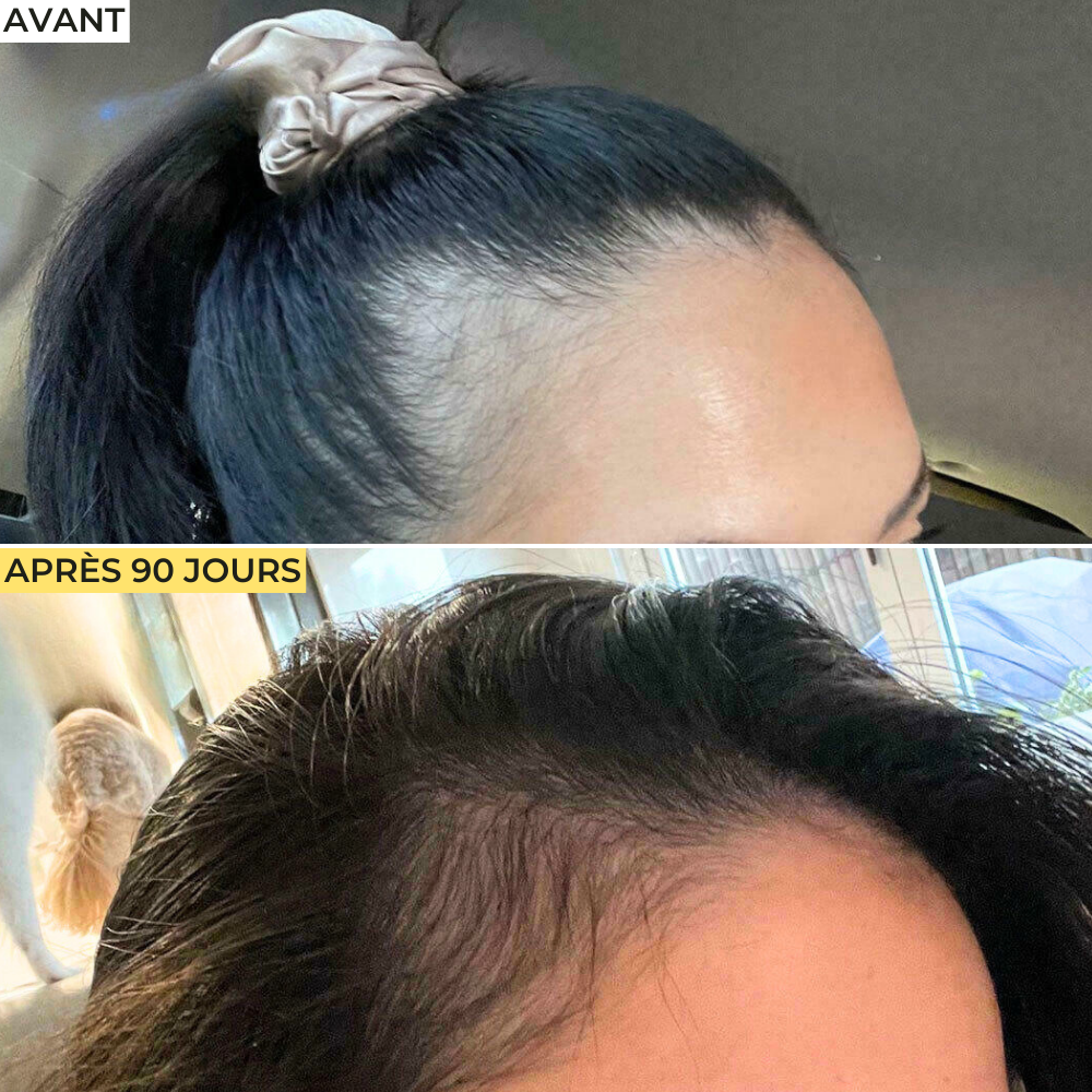 Cure Cheveux Anti-Chute